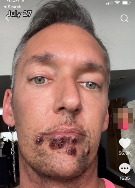 Что делает оспа обезьян с лицом. Фото пациентов Что делает оспа обезьян с лицом. Фото пациентов