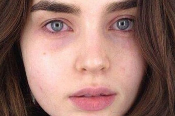 Почему возникают синяки под глазами, как от них избавиться? Почему возникают синяки под глазами, как от них избавиться?