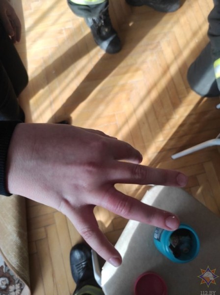 В Беларуси спасатели помогли снять застрявшее кольцо с пальца 8-летней девочки. Смотрите видео и фото В Беларуси спасатели помогли снять застрявшее кольцо с пальца 8-летней девочки. Смотрите видео и фото